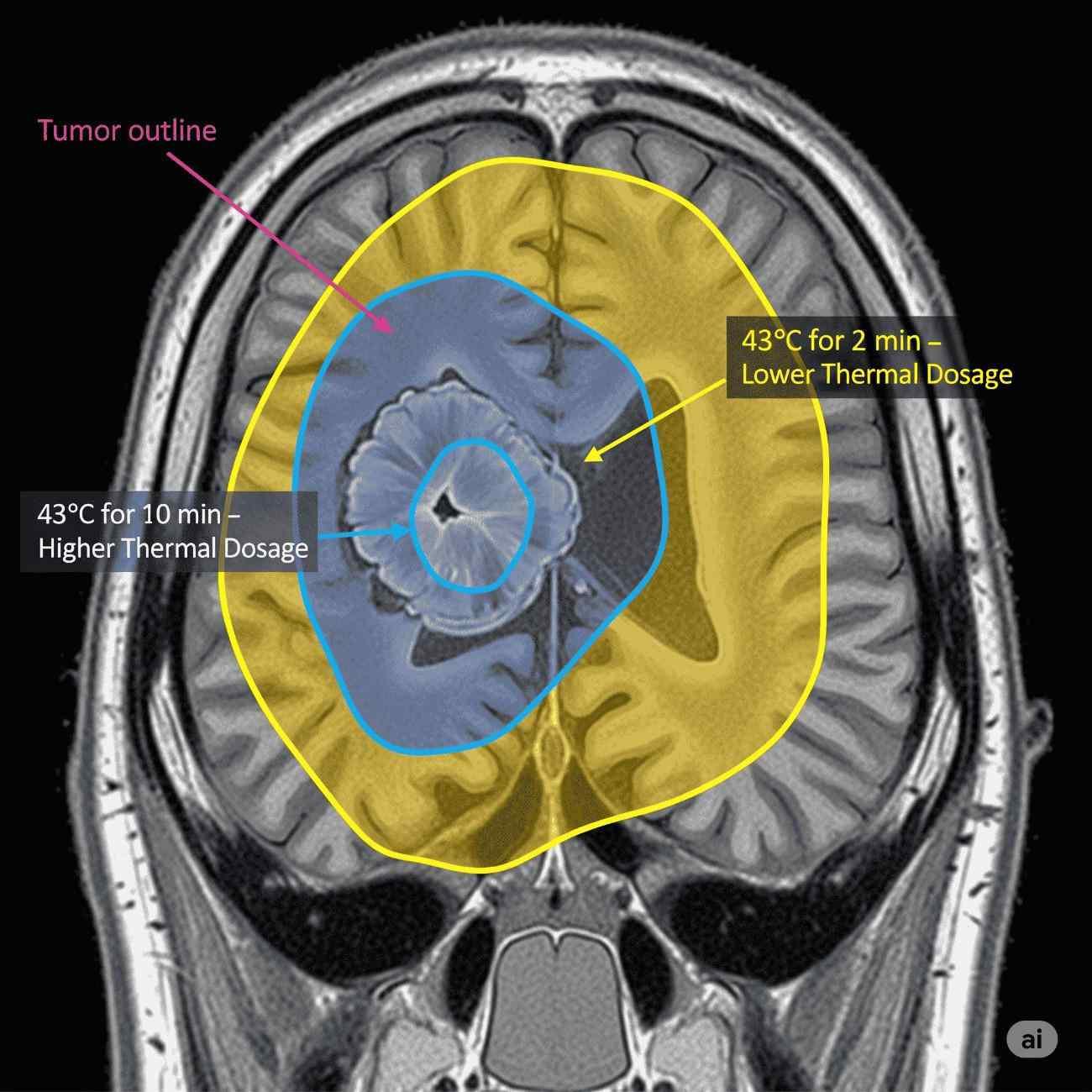 Thermal dosage zones in LITT MRI scan